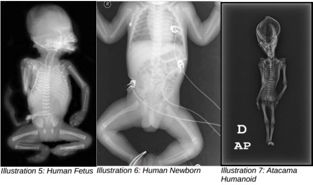 A comparison of foetus x-rays show a remarkable difference between human fetus skeletal development and the x-rays of the Atacama humanoid, the researchers claim in a report published today